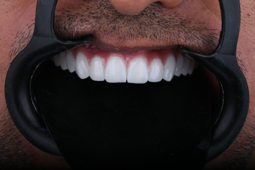 ایمپلنت کامل فک بالا
