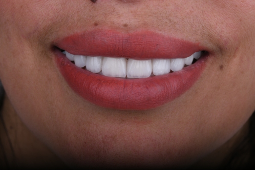 لمینیت فک بالا
