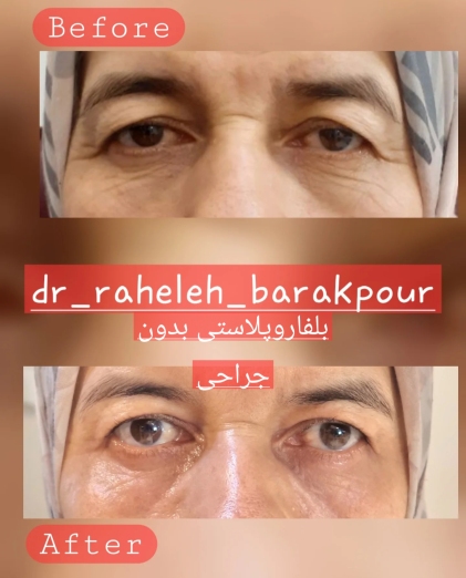 بلفاروپلاستی غیر جراحی