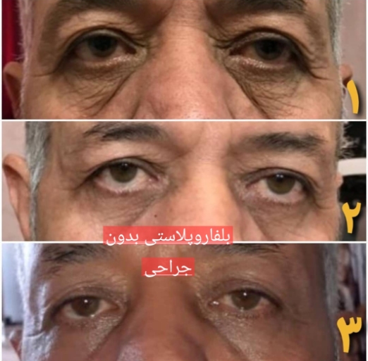 بلفاروپلاستی غیر جراحی
