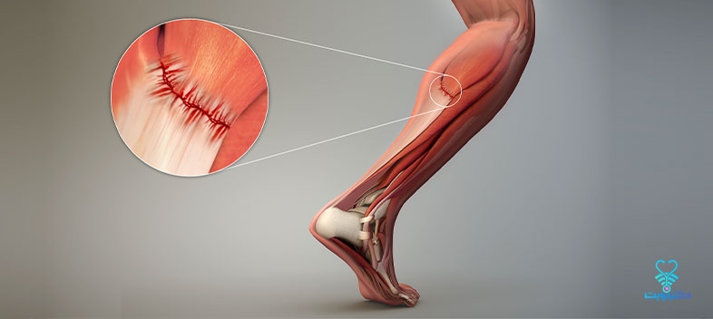 پارگی تاندون چیست و چگونه درمان می شود؟