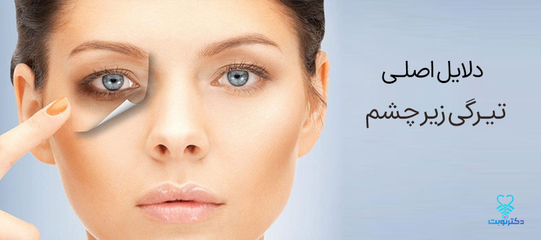 دلایل اصلی تیرگی زیر چشم
