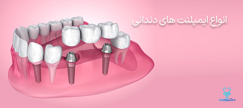 انواع ایمپلنت های دندانی